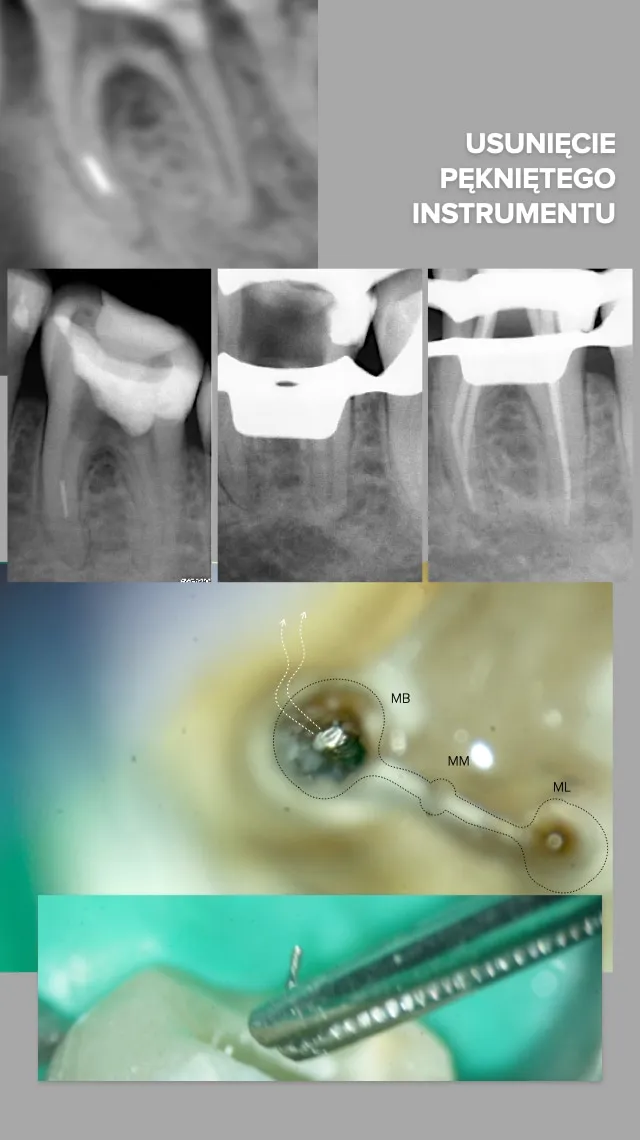 Plansza kliniczna zatytułowana „Usunięcie pękniętego instrumentu”, złożona z sześciu obrazów. U góry przekrój tomografii komputerowej. Poniżej rząd trzech zdjęć rentgenowskich tego samego zęba trzonowego. Pod nimi duży kadr spod mikroskopu: dno komory zęba z trzema ujściami kanałów opisanymi MB, MM i ML, obrysowanymi kropkowaną linią; w ujściu MB metaliczny odłamek, a od niego dwie kropkowane strzałki ku górze. Na dole zdjęcie metalowego narzędzia z cienkim fragmentem na końcówce, uniesionego nad zębem, na tle zielonego koferdamu.