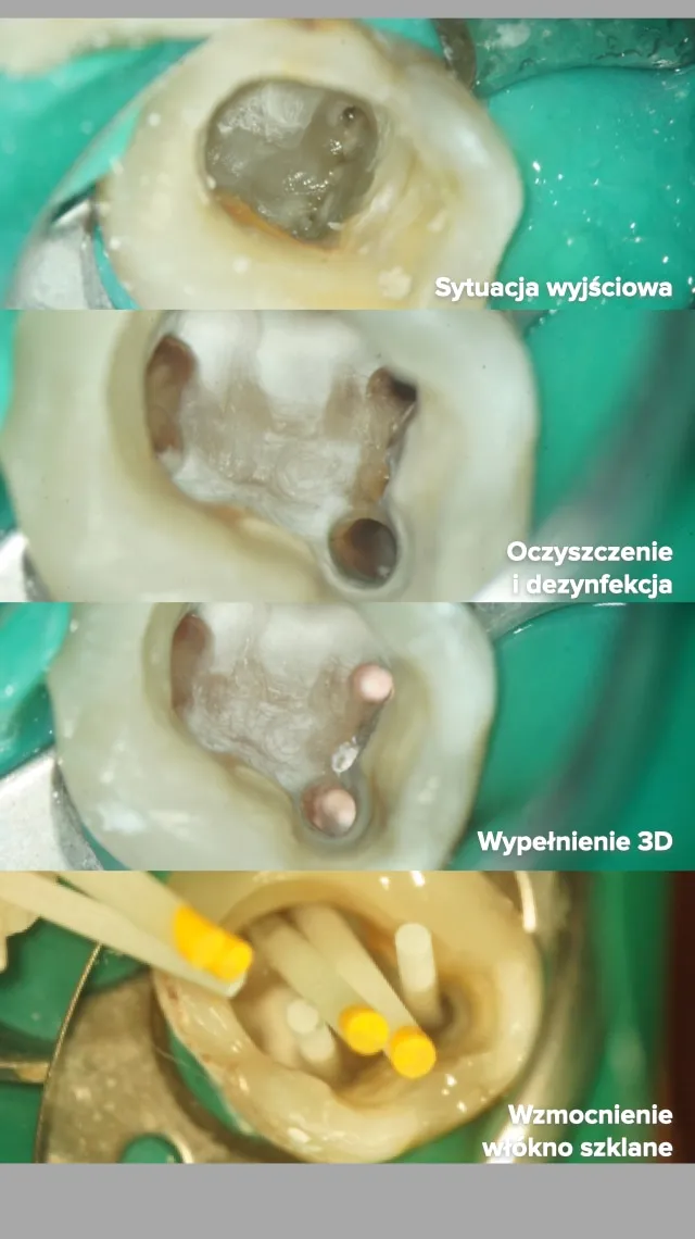 Plansza kliniczna złożona z czterech kadrów spod mikroskopu, jeden pod drugim, każdy podpisany. „Sytuacja wyjściowa” - dno komory zęba wypełnione ciemną tkanką. „Oczyszczenie i dezynfekcja” - ta sama komora po opracowaniu, z widocznymi ciemnymi ujściami kanałów. „Wypełnienie 3D” - ujścia kanałów zamknięte różowym materiałem. „Wzmocnienie włókno szklane” - jasne włókna osadzone w kanałach, część z żółtymi końcówkami. Wszystkie kadry na tle zielonego koferdamu.